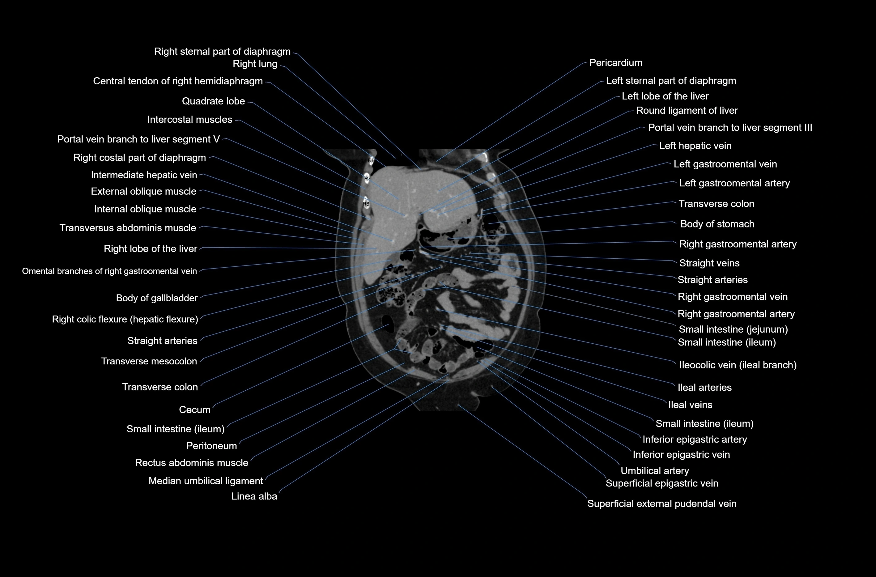 CT abdomen coronal cross sectional anatomy labelled radiology image-00021.webp